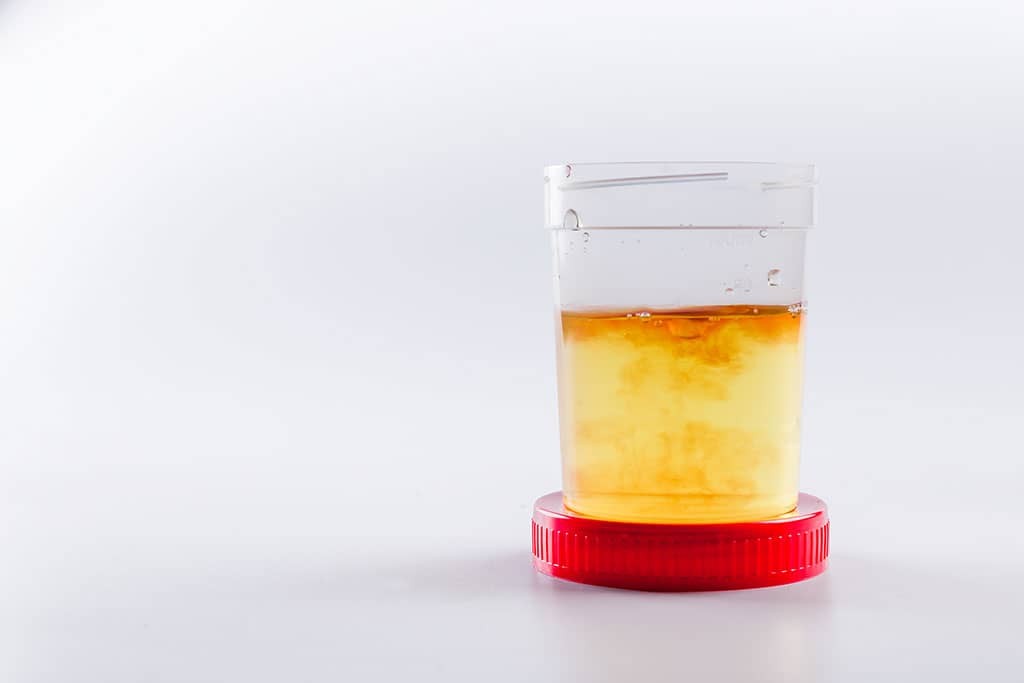 bloody-urine